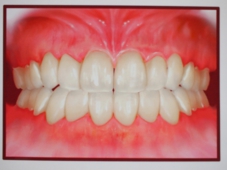 健康な歯の口腔内写真.jpg